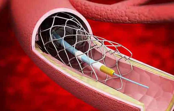 全國高值耗材集采靴子落地，百億冠脈支架市場將行業(yè)洗牌